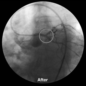 y-stenting_after